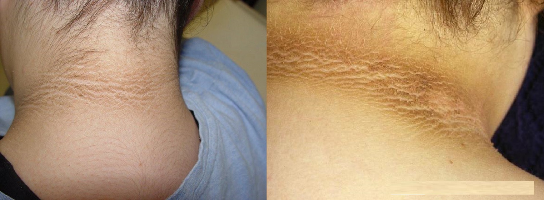 The Truth About That Dark Ring On The Neck And Diabetes DailyPedia